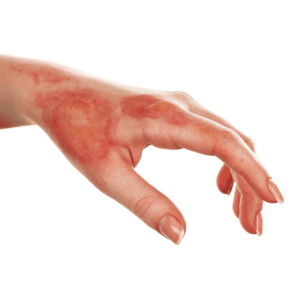 Letselschade brandwond hand